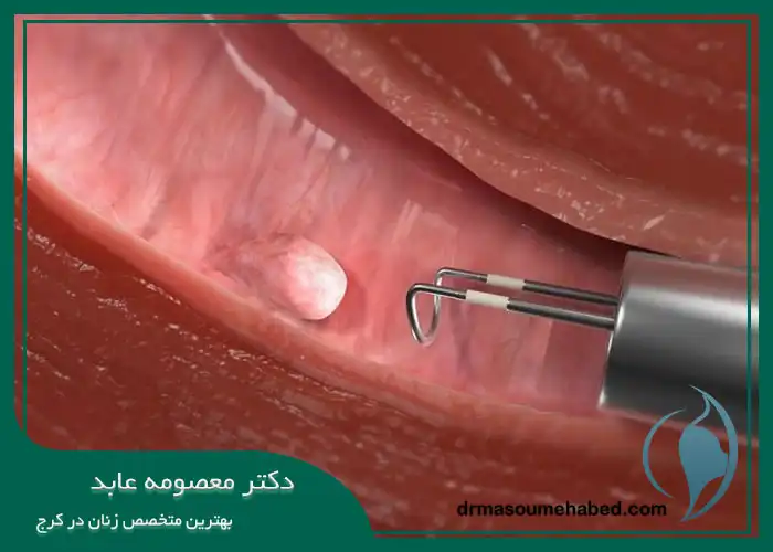 هیستروسکوپی پولیپکتومی
