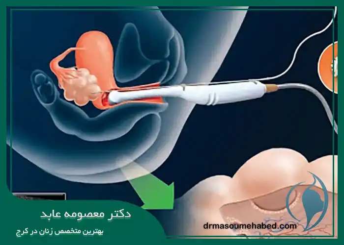 مدت زمان هیستروسکوپی پولیپکتومی