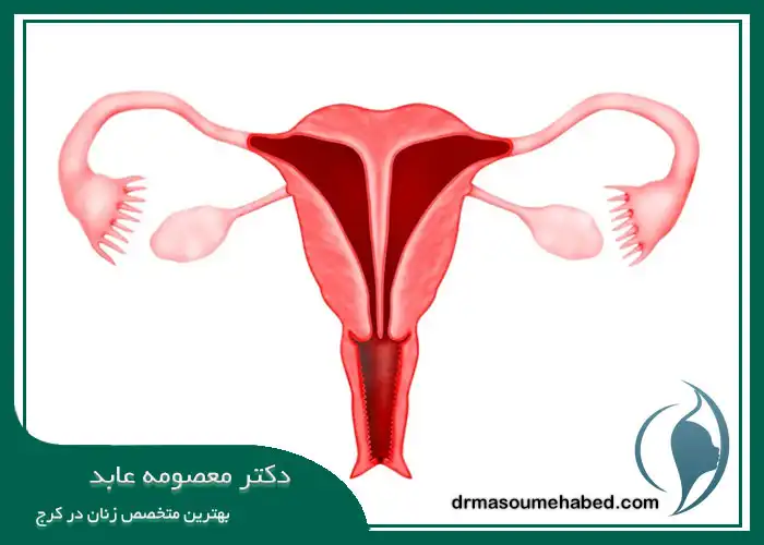 درمان با هیستروسکوپی