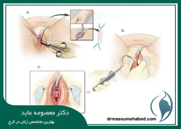 جراحی ترمیمی لابیاپلاستی در کرج