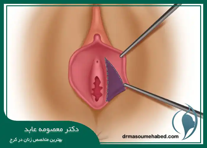 لابیا پلاستی با لیزر بهتر است یا جراحی؟