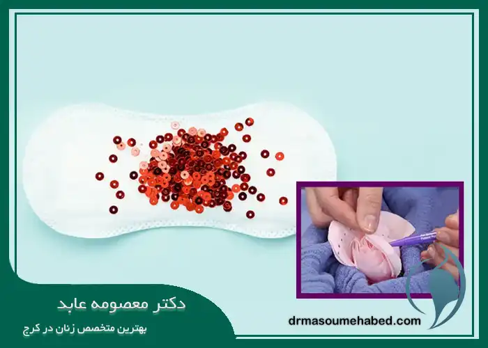 پریود بعد از لابیاپلاستی