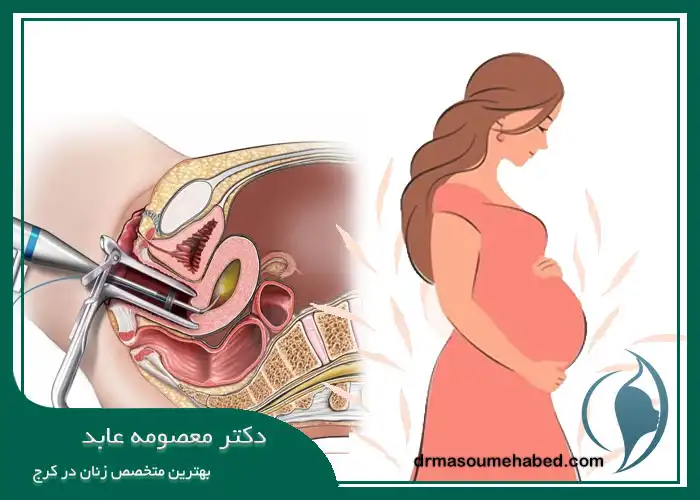 بارداری بعد از هیستروسکوپی