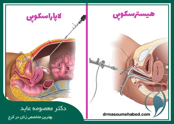 ۶ تفاوت اصلی هیستروسکوپی و لاپاراسکوپی