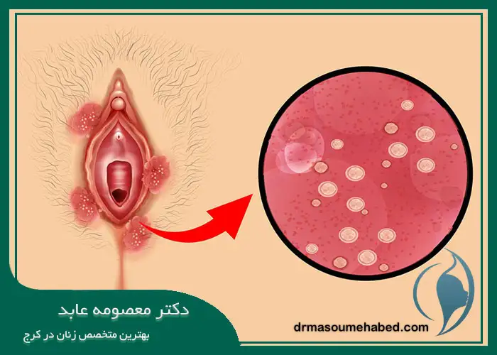 بهترین دکتر درمان زگیل تناسلی در کرج
