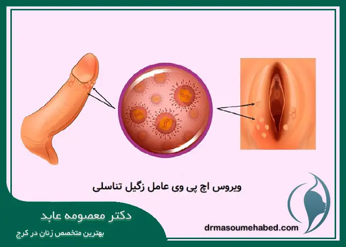 زگیل تناسلی زنان