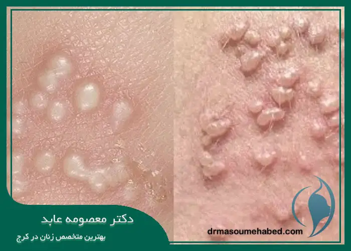 علائم زگیل تناسلی