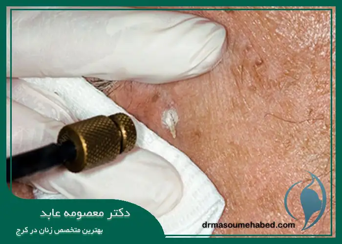 بهترین درمان برای زگیل تناسلی