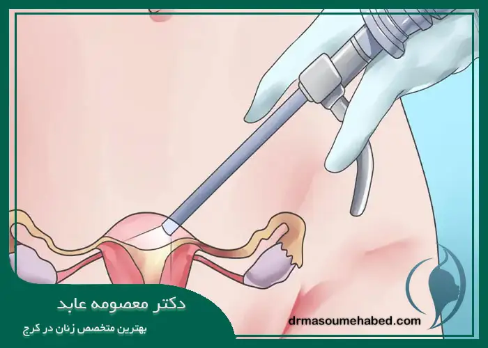 هیسترکتومی با حفظ تخمدان در کرج