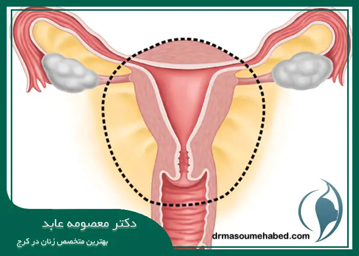 هزینه نهایی هیسترکتومی با حفظ تخمدان