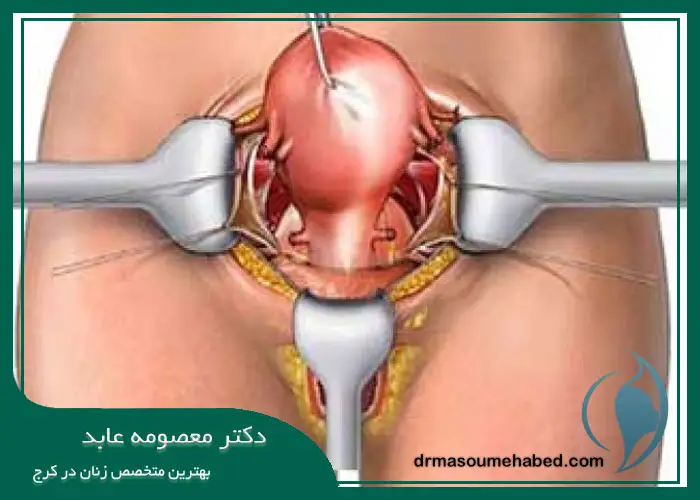جراحی هیسترکتومی با حفظ تخمدان