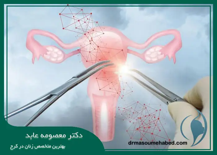 مزایای انجام هیستروسکوپی میومکتومی