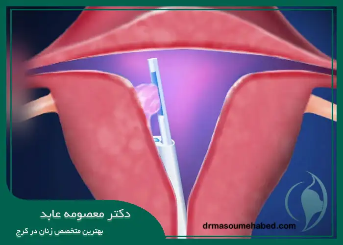 مراقبت ‌های قبل و بعد از هیستروسکوپی میومکتومی