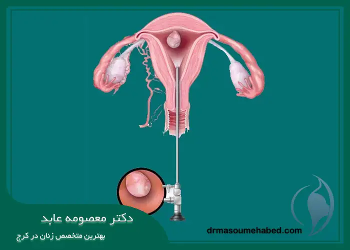 هیستروسکوپی میومکتومی