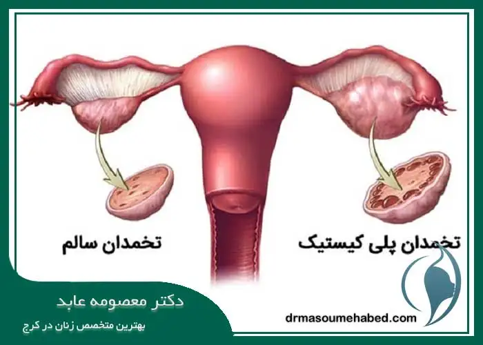 بهترین پزشک برای درمان تخمدان پلی کیستیک کرج