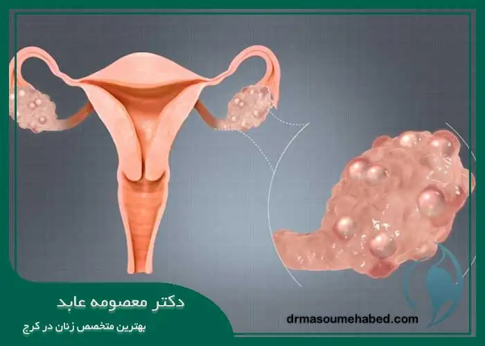 عوامل موثر در ایجاد تخمدان پلیکیستیک