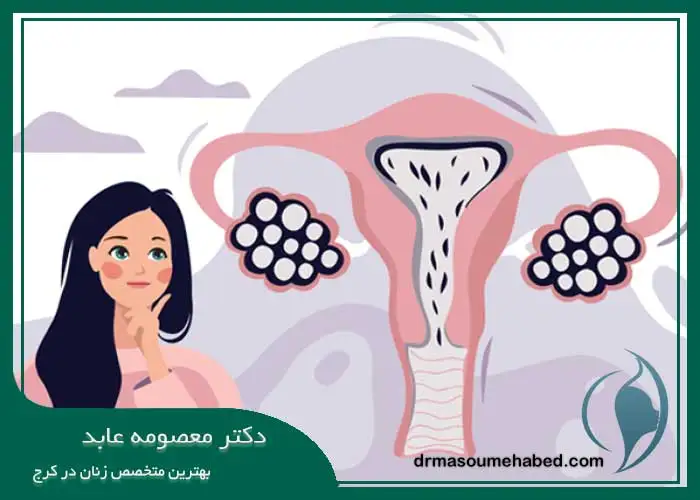 درمان تخمدان پلی کیستیک