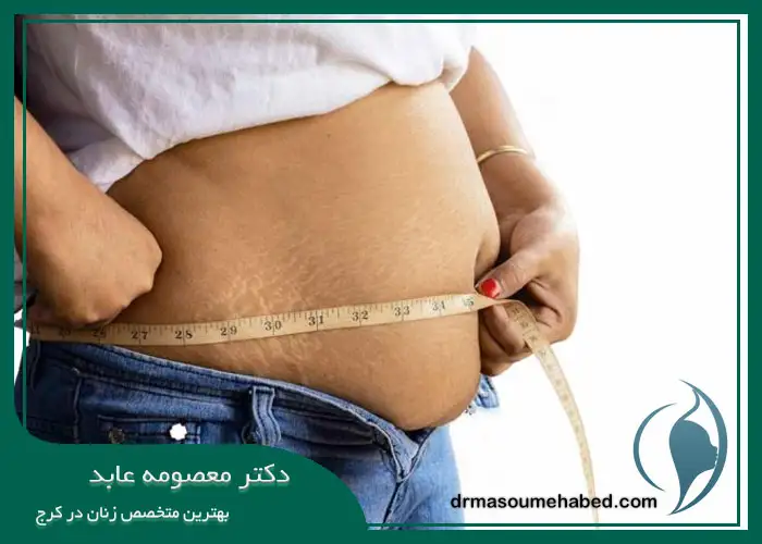 درمان بی اختیاری ادرار بعد از زایمان با کاهش وزن