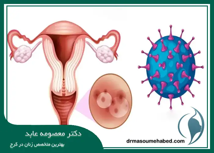 درمان تبخال تناسلی در کرج
