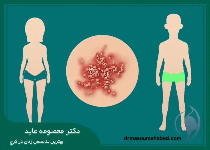 روش های انتقال تبخال تناسلی