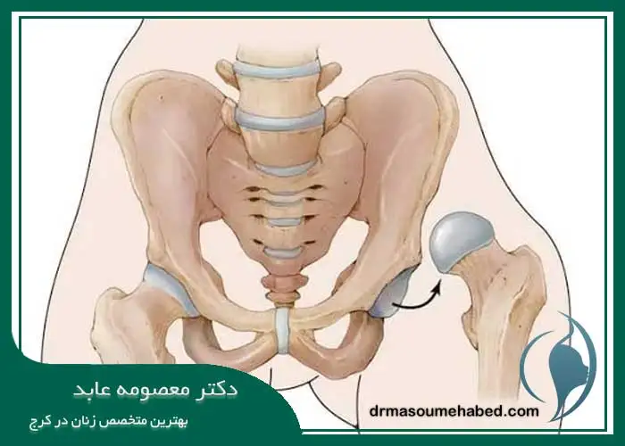 دررفتگی لگن