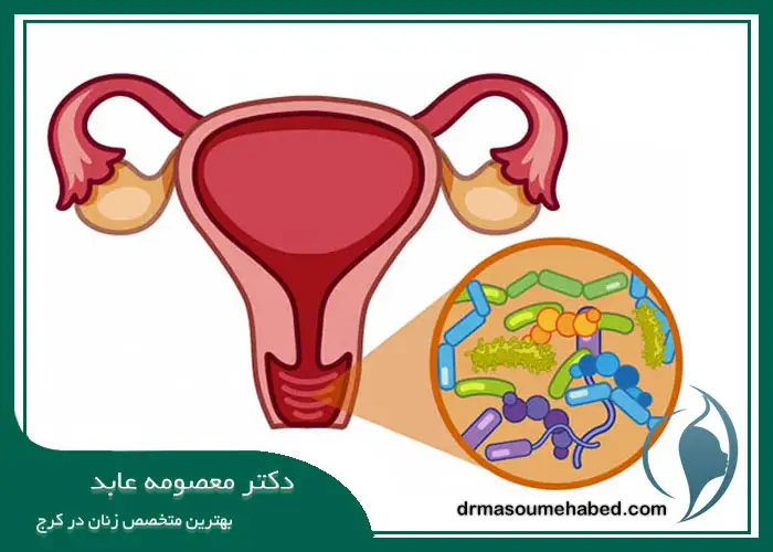 روش‌ های درمانی برای عفونت ‌های زنانه در کرج