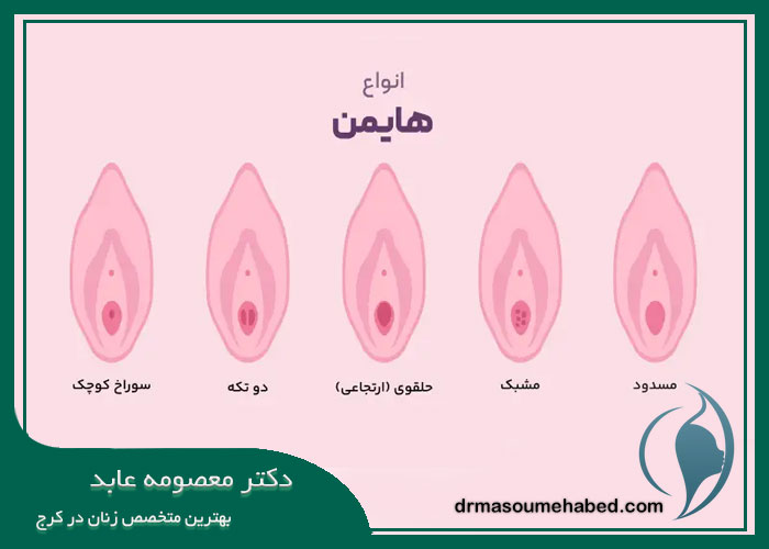 انواع هایمن