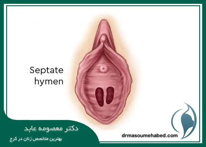 هایمن سپتوم‌دار یا تیغه‌ای