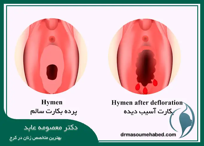نشانه های پارگی پرده بکارت