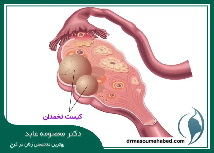 کیست تخمدان در پریودی