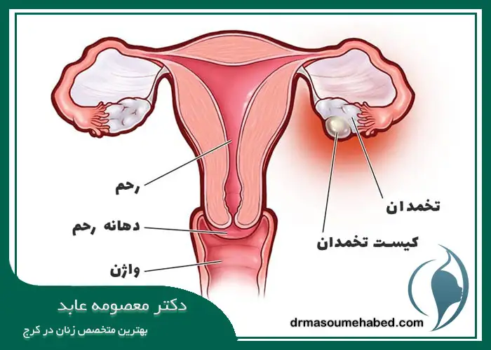 علت‌های ایجاد کیست تخمدان
