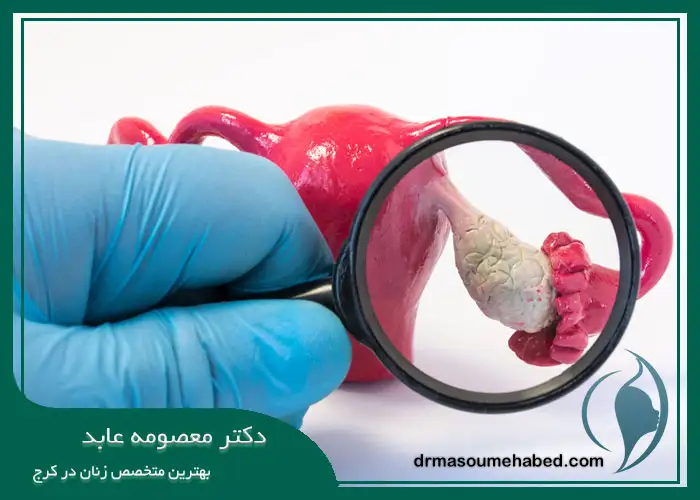 علائم کیست تخمدان در دختران مجرد