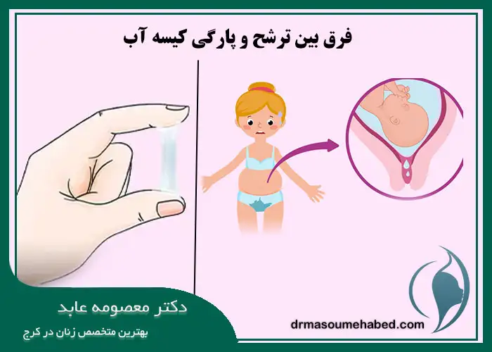 فرق بین ترشح و پارگی کیسه آب