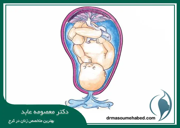 علت پاره شدن کیسه آب جنین