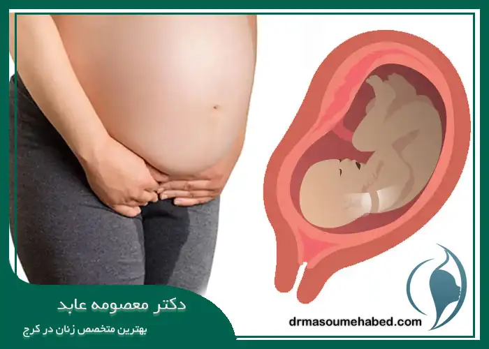 علائم پاره شدن کیسه آب