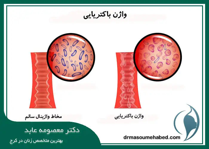 عفونت باکتریایی واژن و خارش