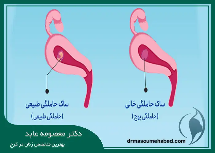 بارداری پوچ چیست