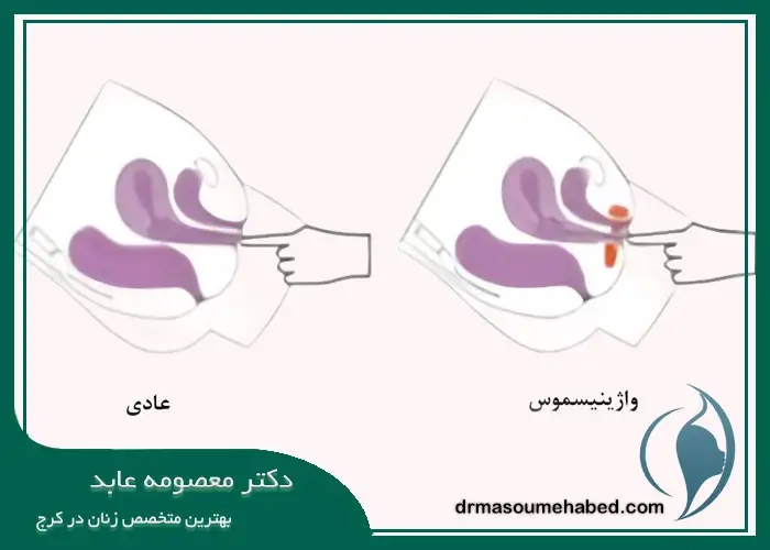 انقباض عضلات کف لگن (واژینیسموس)
