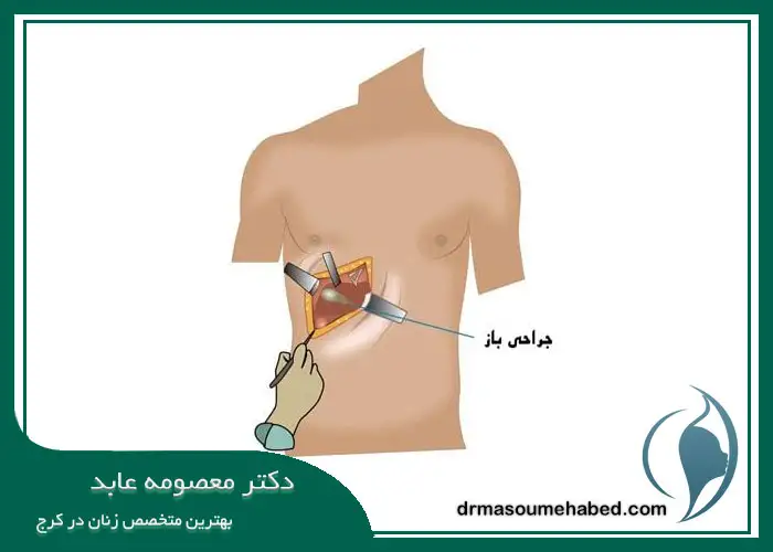 جراحی لاپاراتومی در کرج