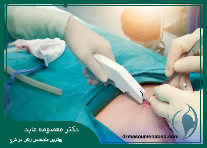مراحل انجام جراحی لاپاراتومی در کرج