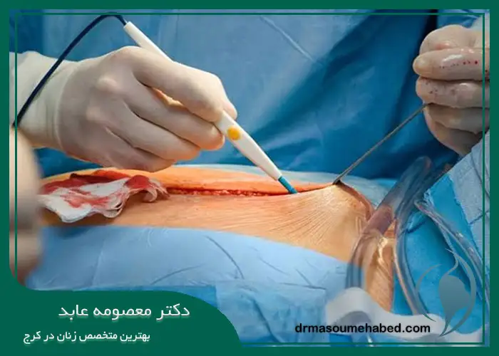 مزایای جراحی لاپاراتومی
