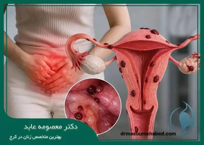 درد زیر شکم در زنان و اندومتریوز