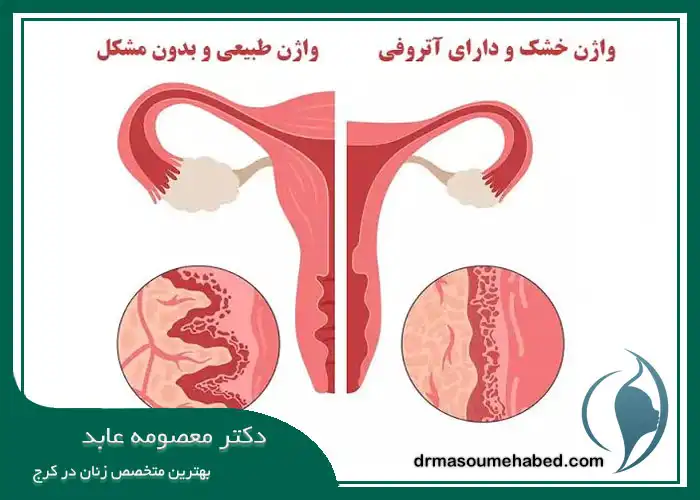 درمان خشکی واژن در کرج